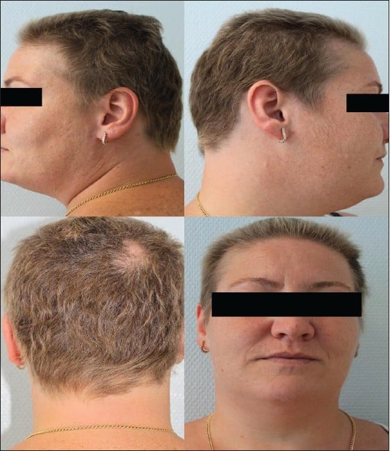 Infliximab Hair Loss