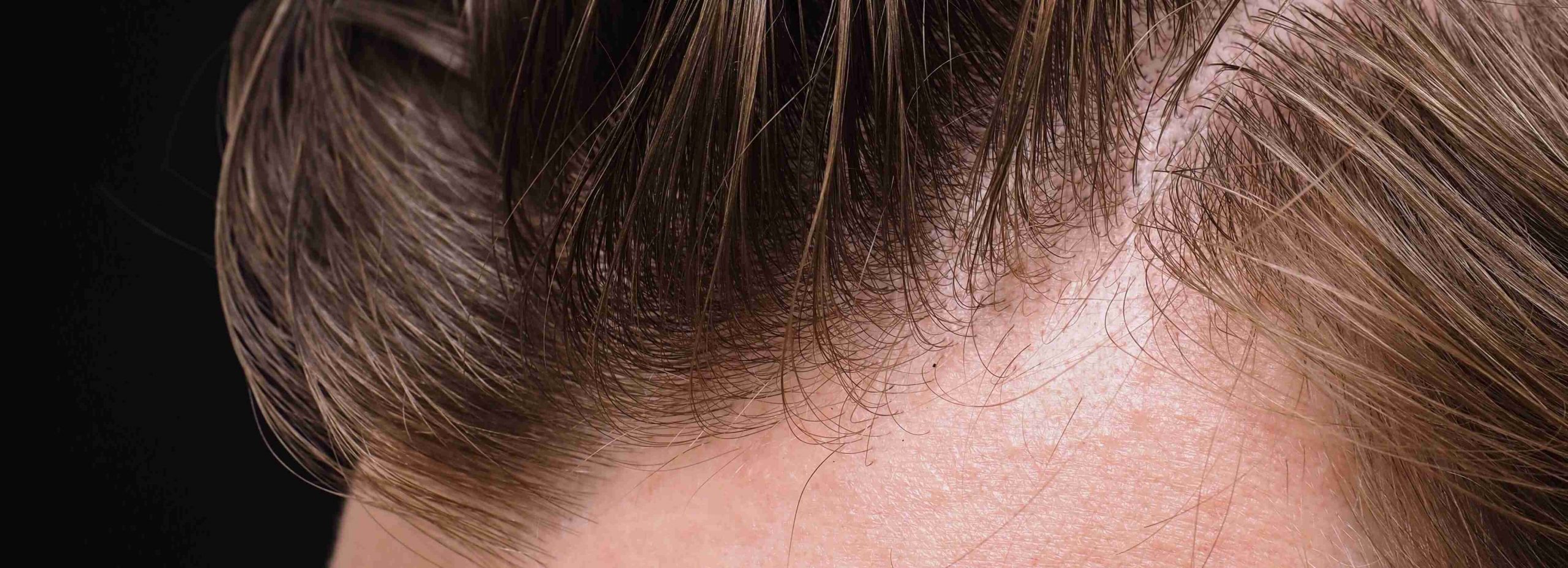 Is Hair Loss Caused by Testosterone?