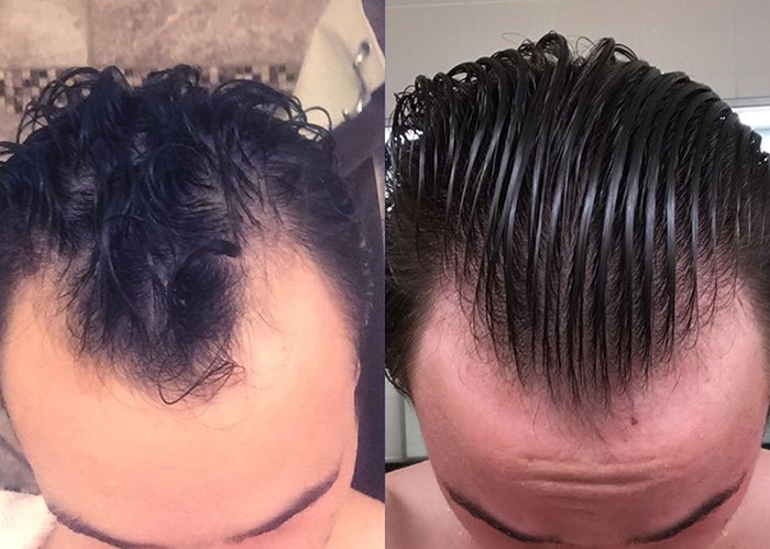 Is it Really Possible to Regrow Your Hair? This Guy Did.