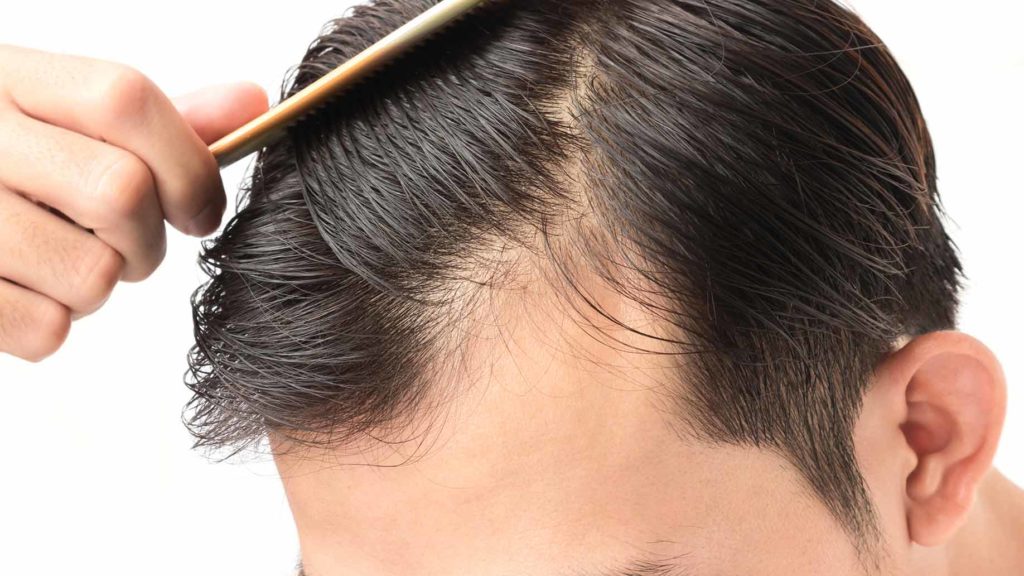 Is It Too Late to Reverse Your Hair Loss?