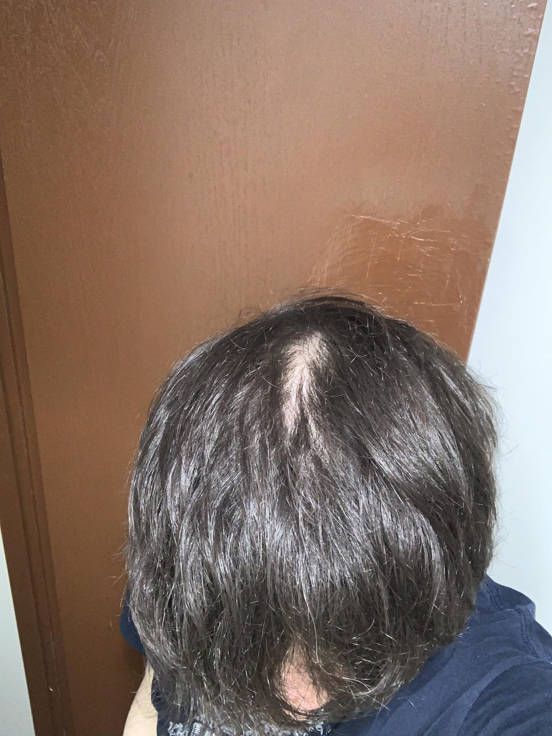 Is my hair significantly thinning or is it just a hair part ...