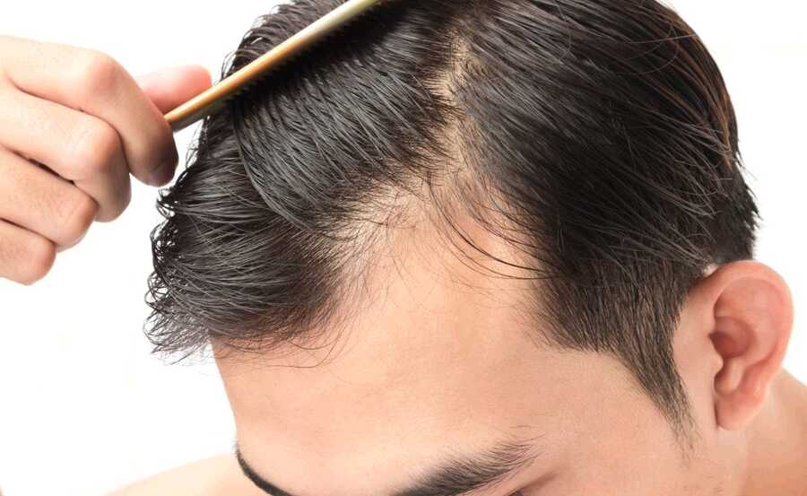 Is There Anything You Can Do to Prevent Premature Male Baldness?