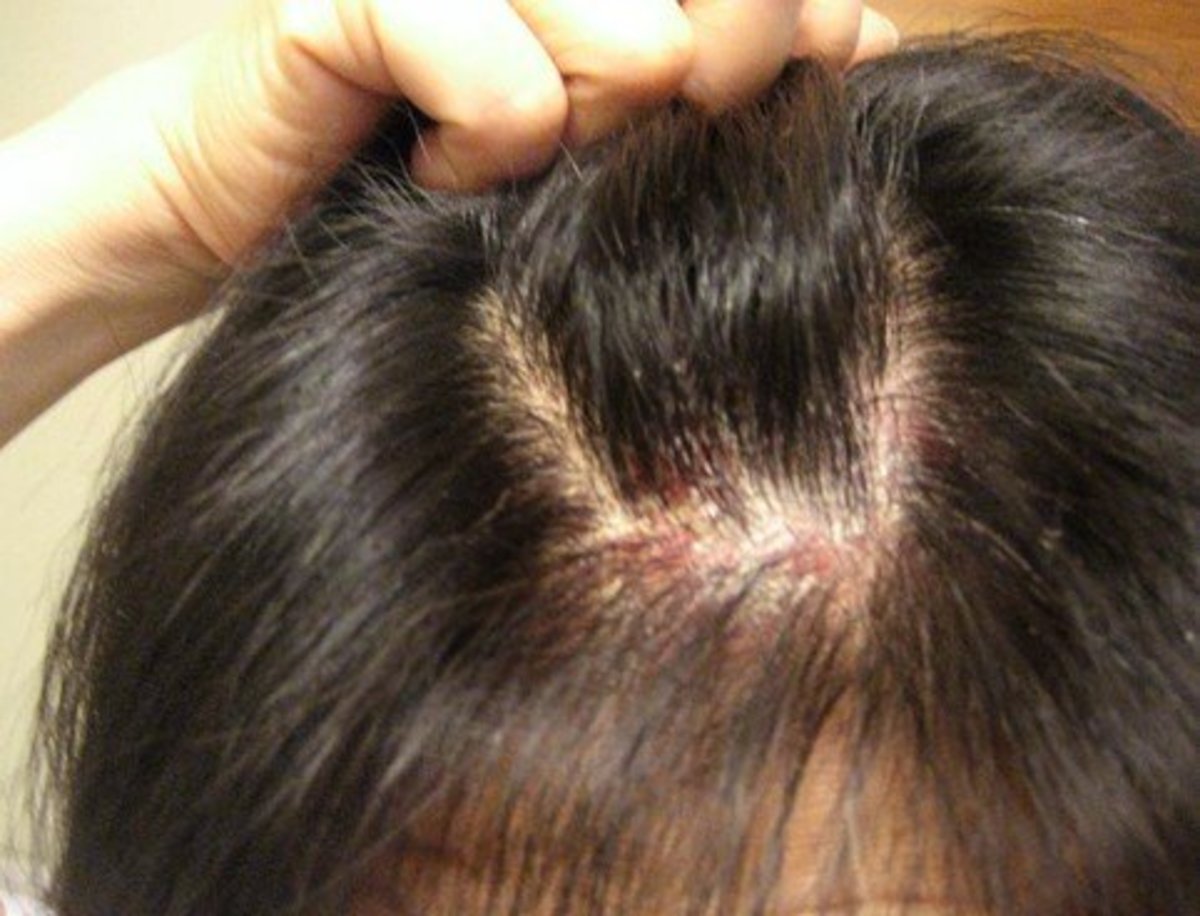 What To Do For Itchy Scalp And Hair Loss - HairLossProTalk.com