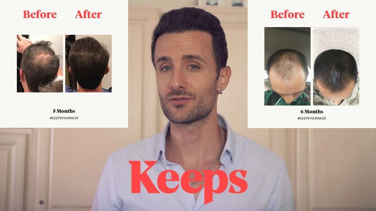 Keeps Hair Loss Review