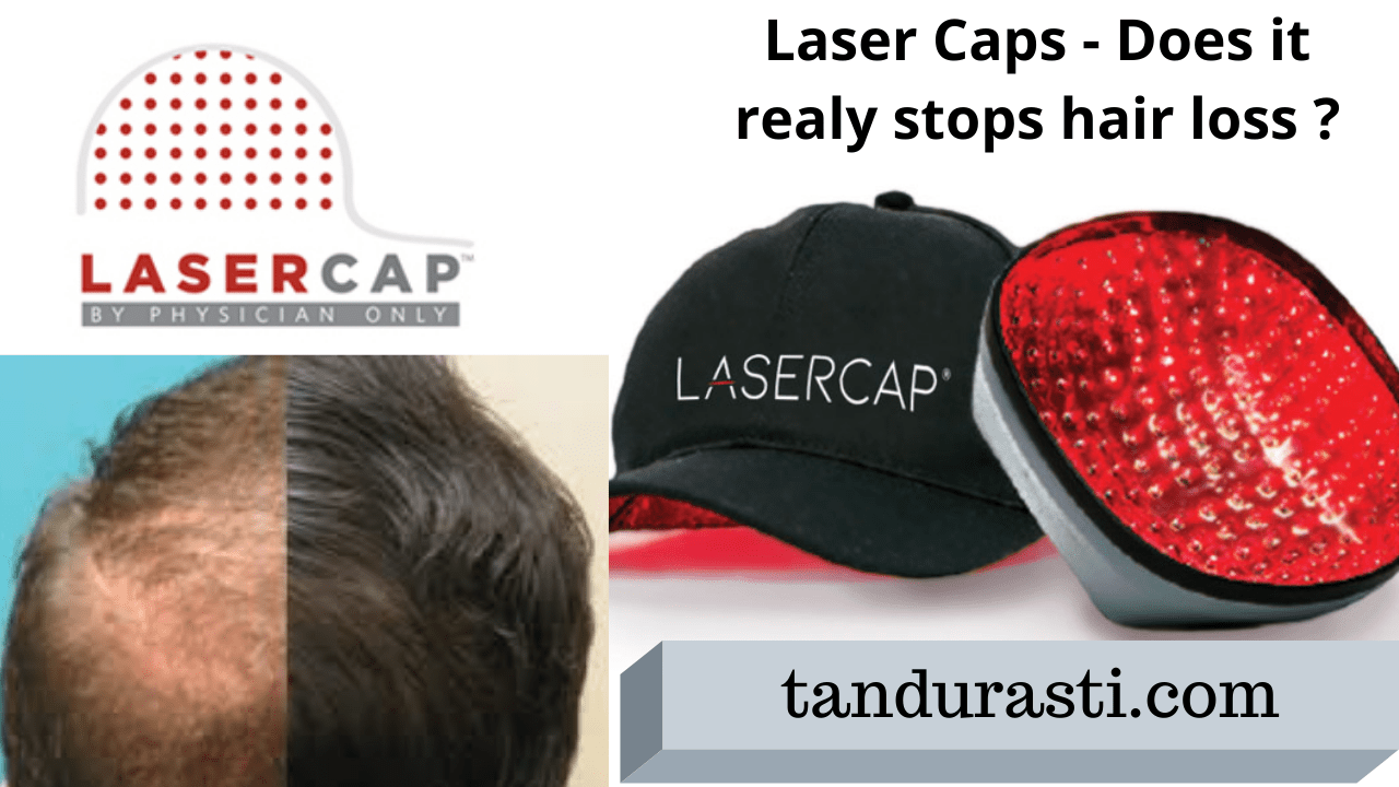 Laser caps really useful for hair loss?