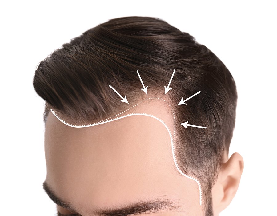 Laser Therapy For Hair Loss: The Benefits and Side Effects