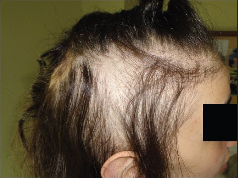 Lead Poisoning Hair Loss / Leads Generation for Businesses ...