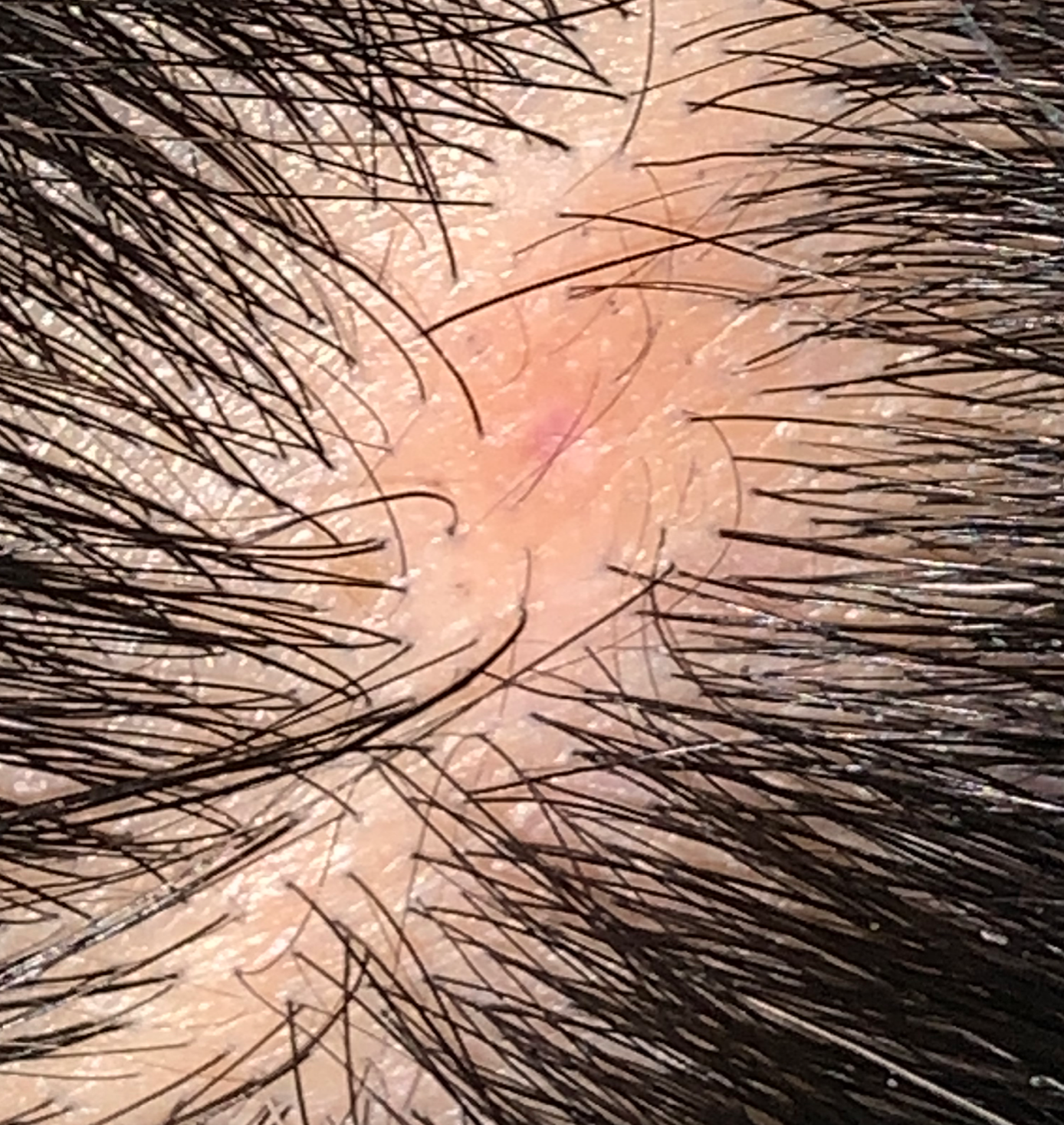 Localized Hair Loss on the Scalp â Donovan Hair Clinic