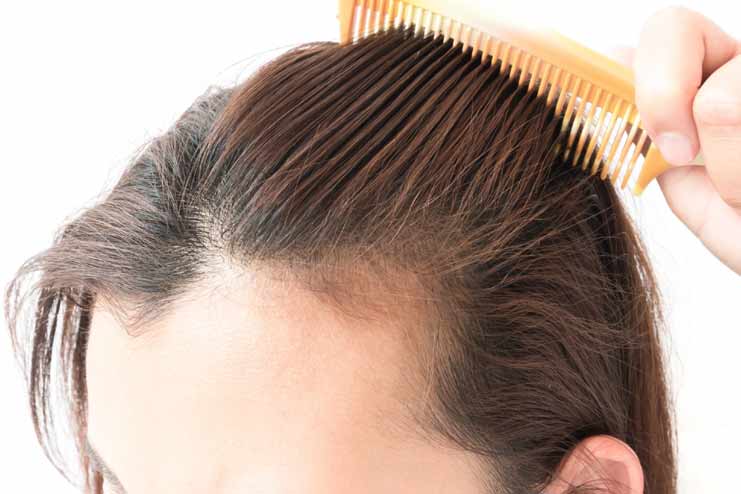 Losing Weight Causes Hair Loss