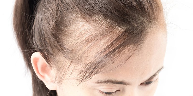 Lupus Hair Loss â Causes, Symptoms And Treatments