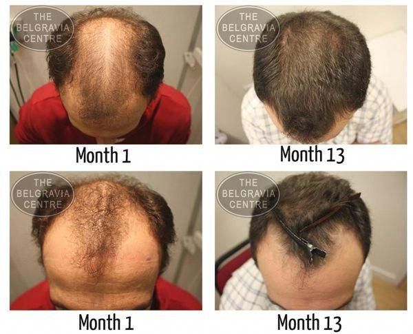 Male Hair Loss Causes By Low Estrogen #hairloss # ...