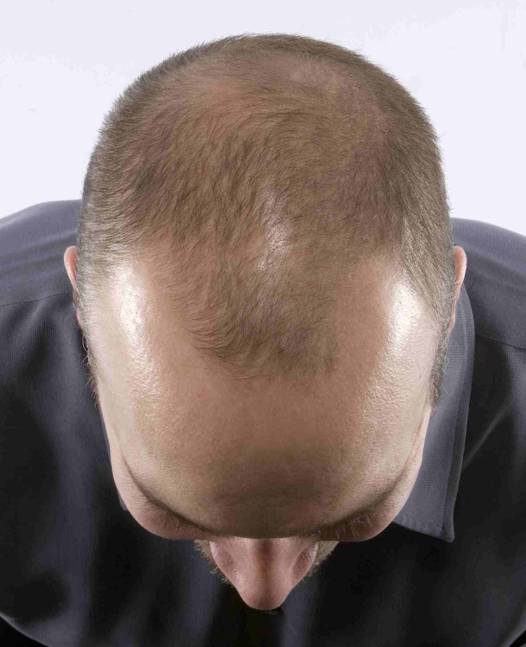 Male pattern baldness ( Androgenic Alopecia )