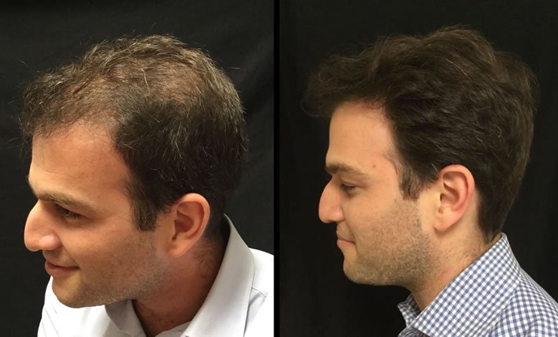 Male with PRP treatment on hair â 4 months