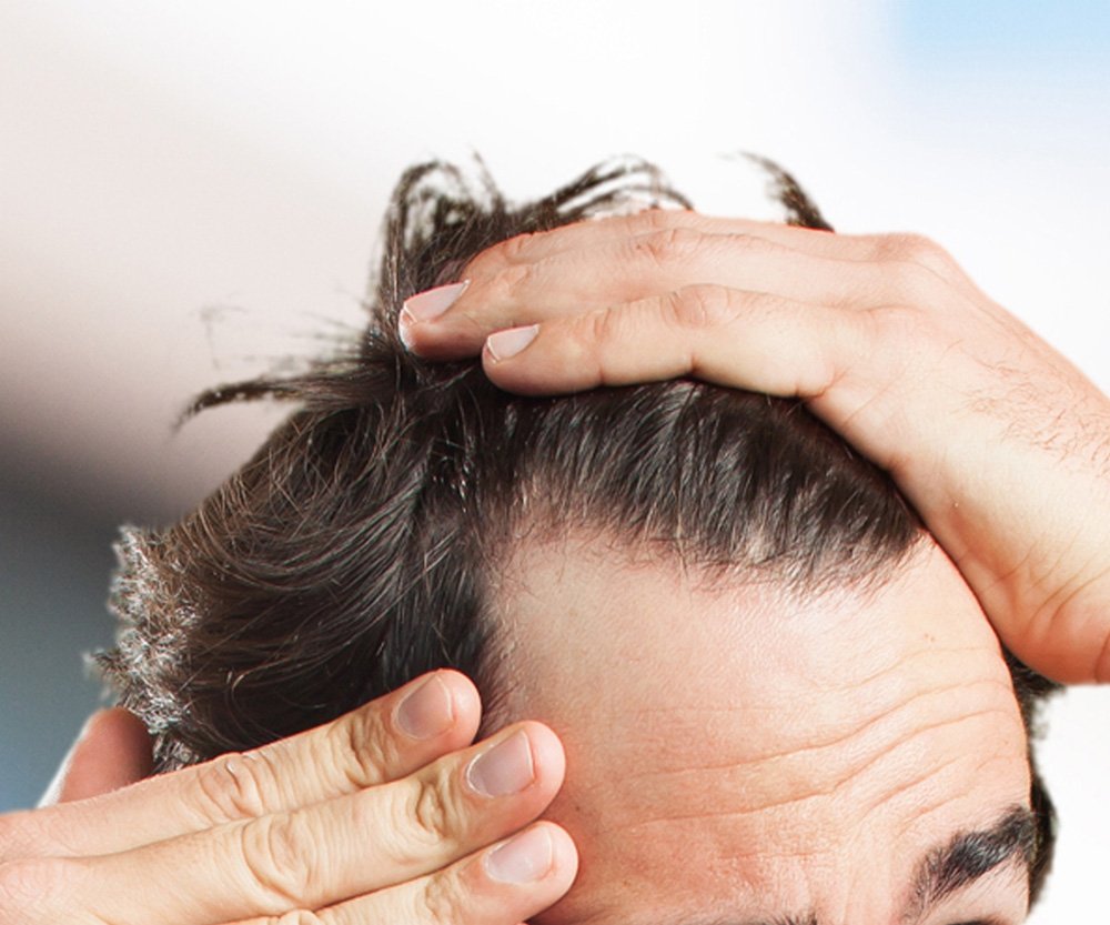 MEN &  HAIR LOSS: CAUSES, TREATMENTS AND SOLUTIONS