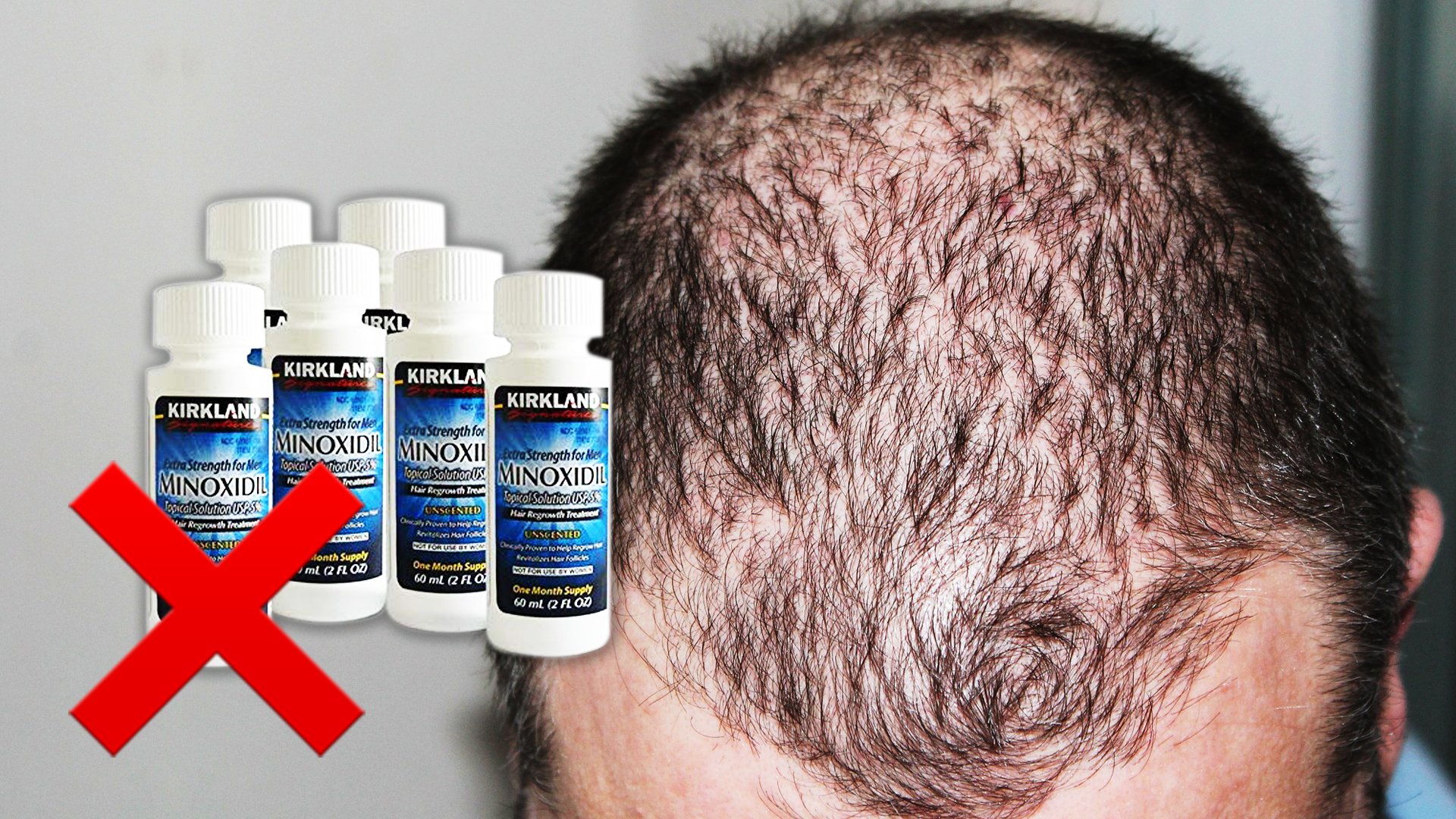 Minoxidil DOES NOT Prevent Hair Loss