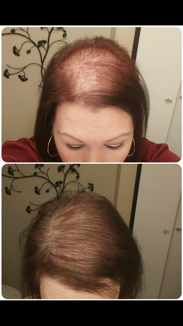 Monat haircare can help thinning, aging, alopecia, hormone ...