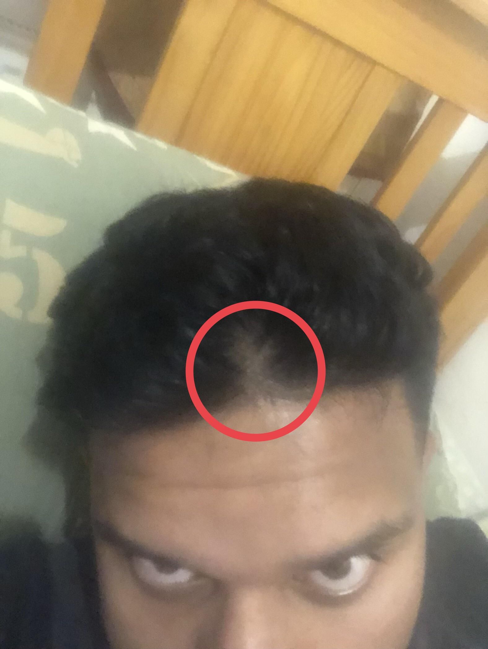 My barber noticed my hair thinning from the front but ...