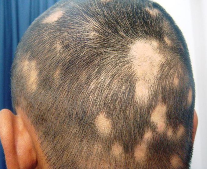 my best Health: Alopecia Areata Hair Loss