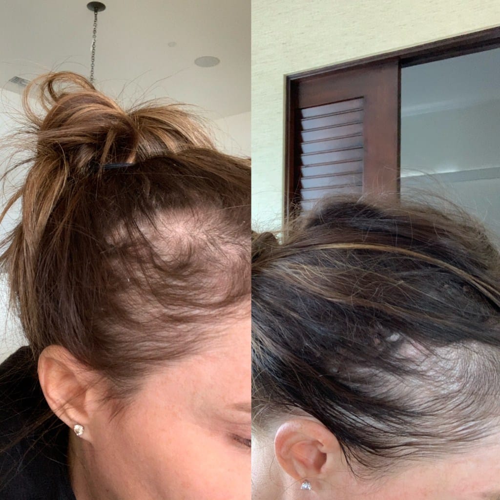 My Postpartum Hair Loss Journey