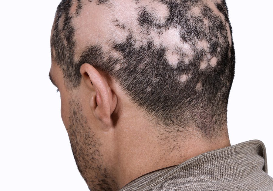 Name Of Hair Loss Disease