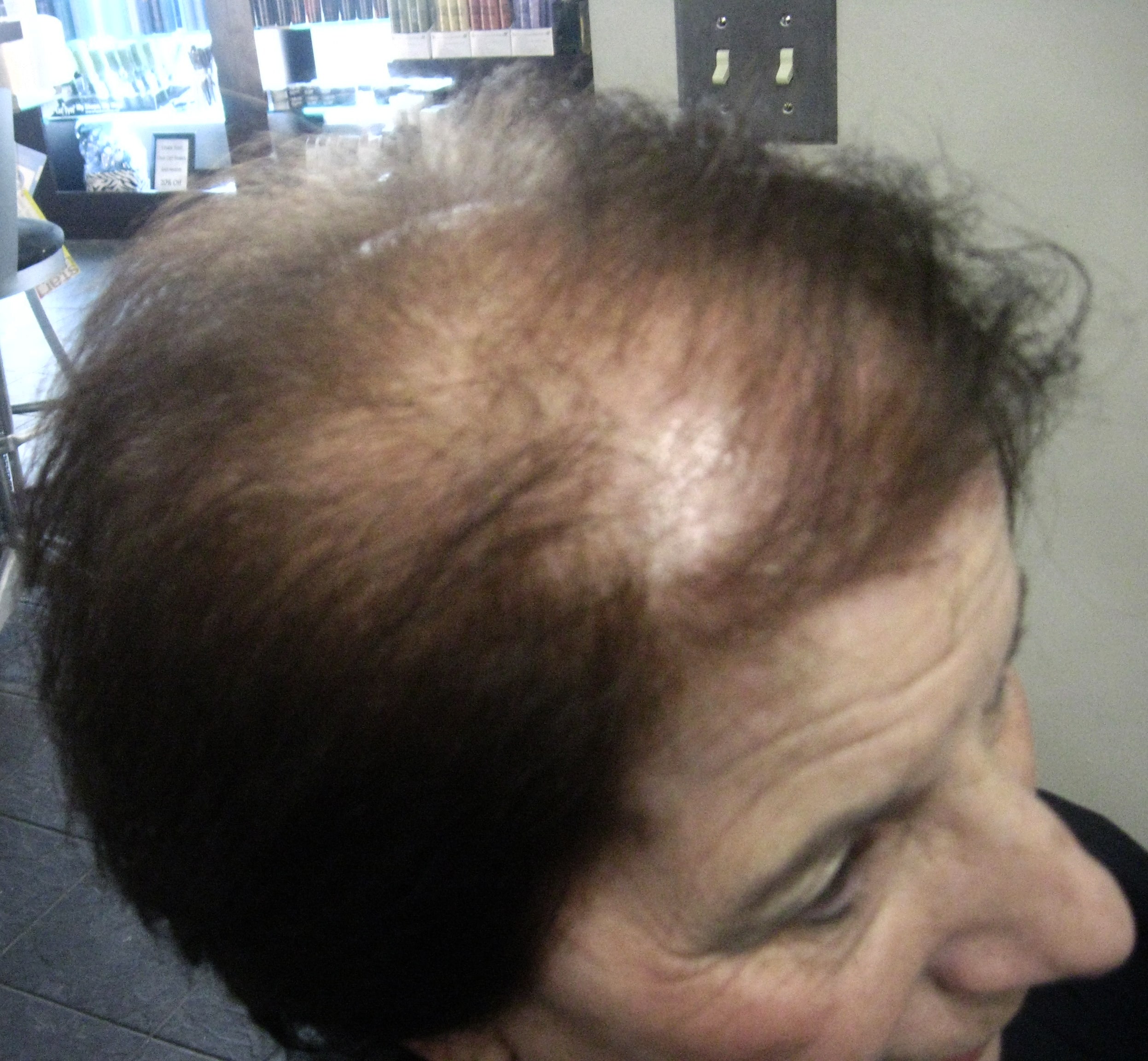 Over 30 Million Women Suffer From Thinning Hair. Now New Techniques ...