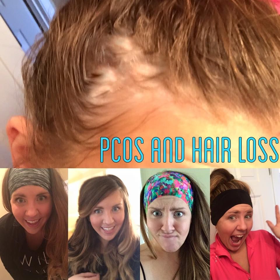 PCOS, Hair loss, and amazing headbands