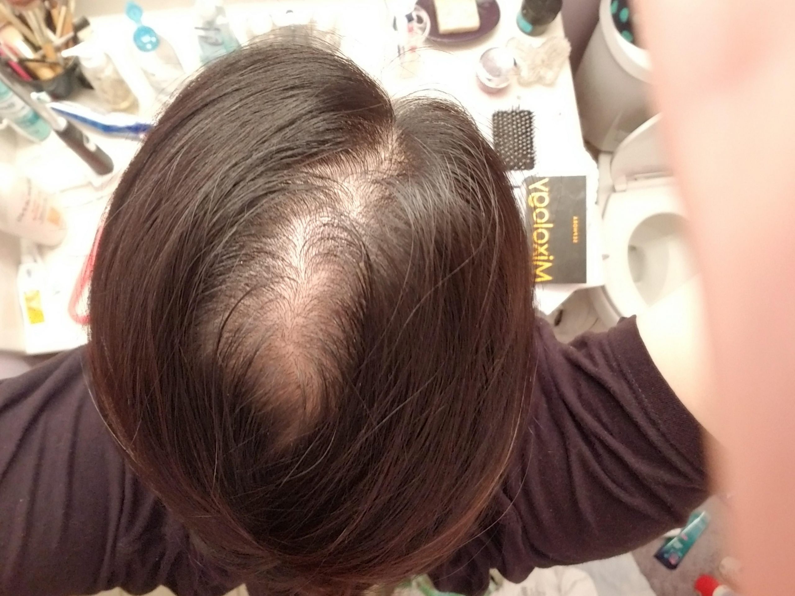 PCOS related hair loss. I