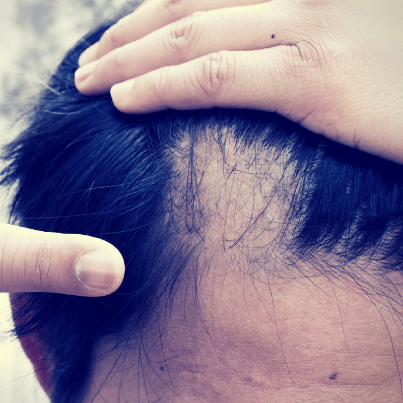 Pin on Hair Loss &  Scalp Conditions