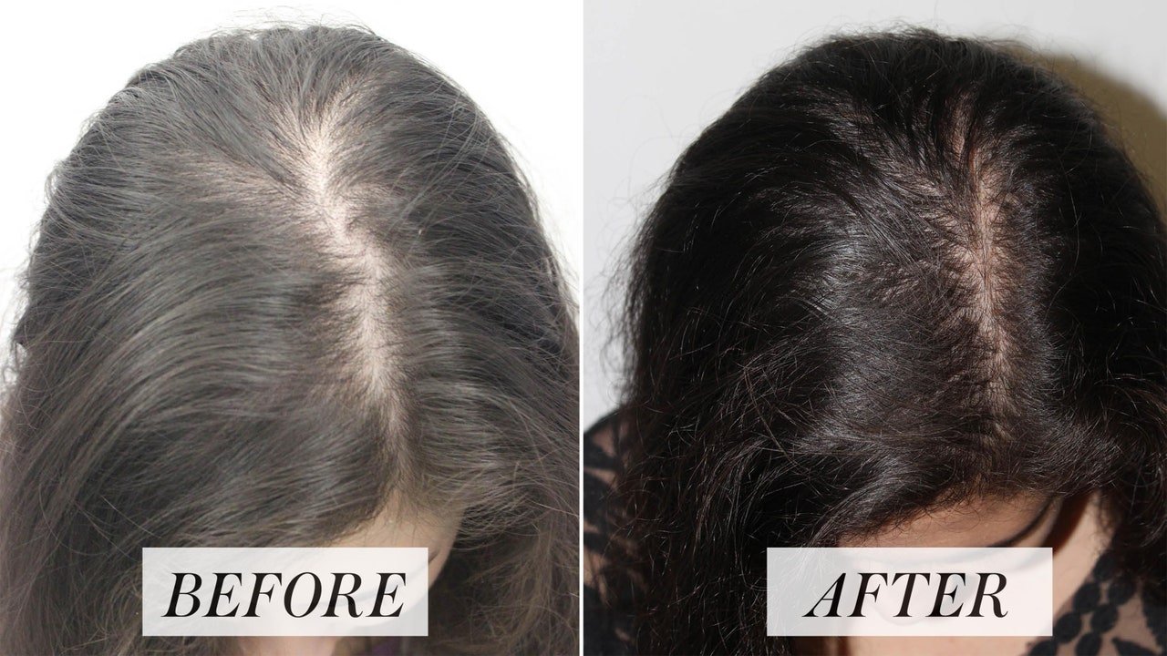 Platelet Rich Plasma Treatment for Hair Loss: Here