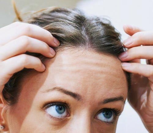 pre menopausal hair loss #HairLossAdvice # ...