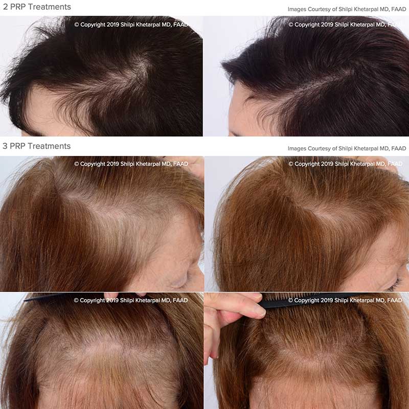 Prp Hair Loss Before And After : How Long Does Prp Hair ...