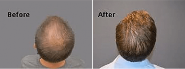 Prp Hair Loss Before And After : How Long Does Prp Hair ...