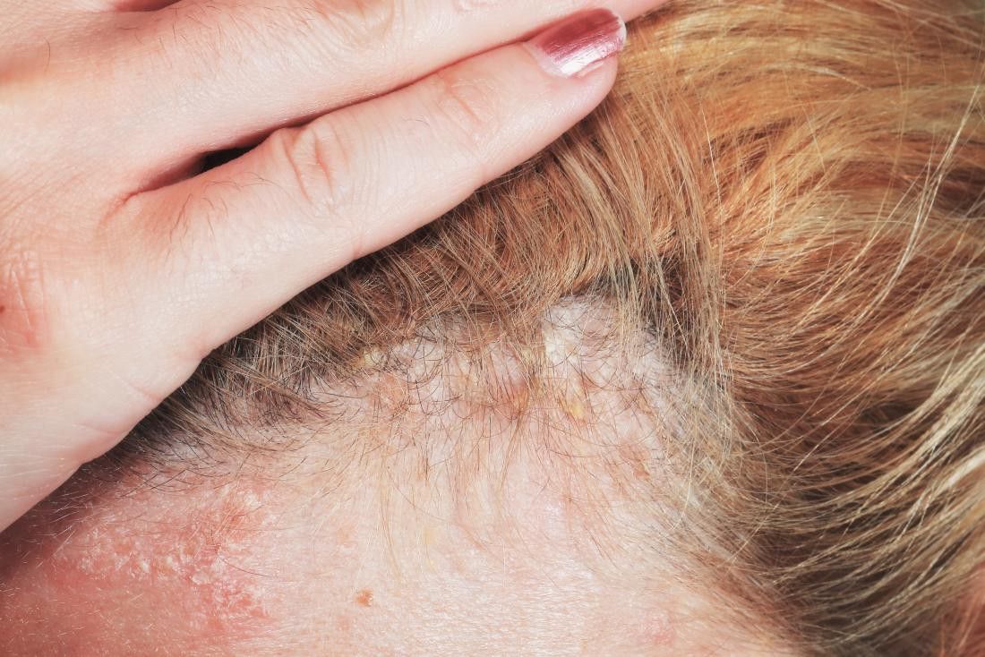 Psoriasis And Hair Health