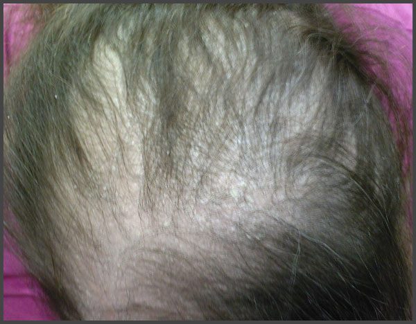 Psoriasis and hair loss pictures