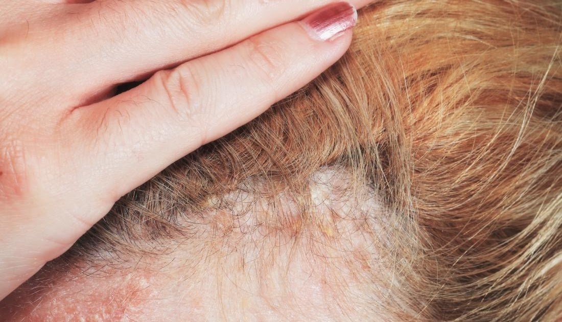 Psoriasis Hair Loss