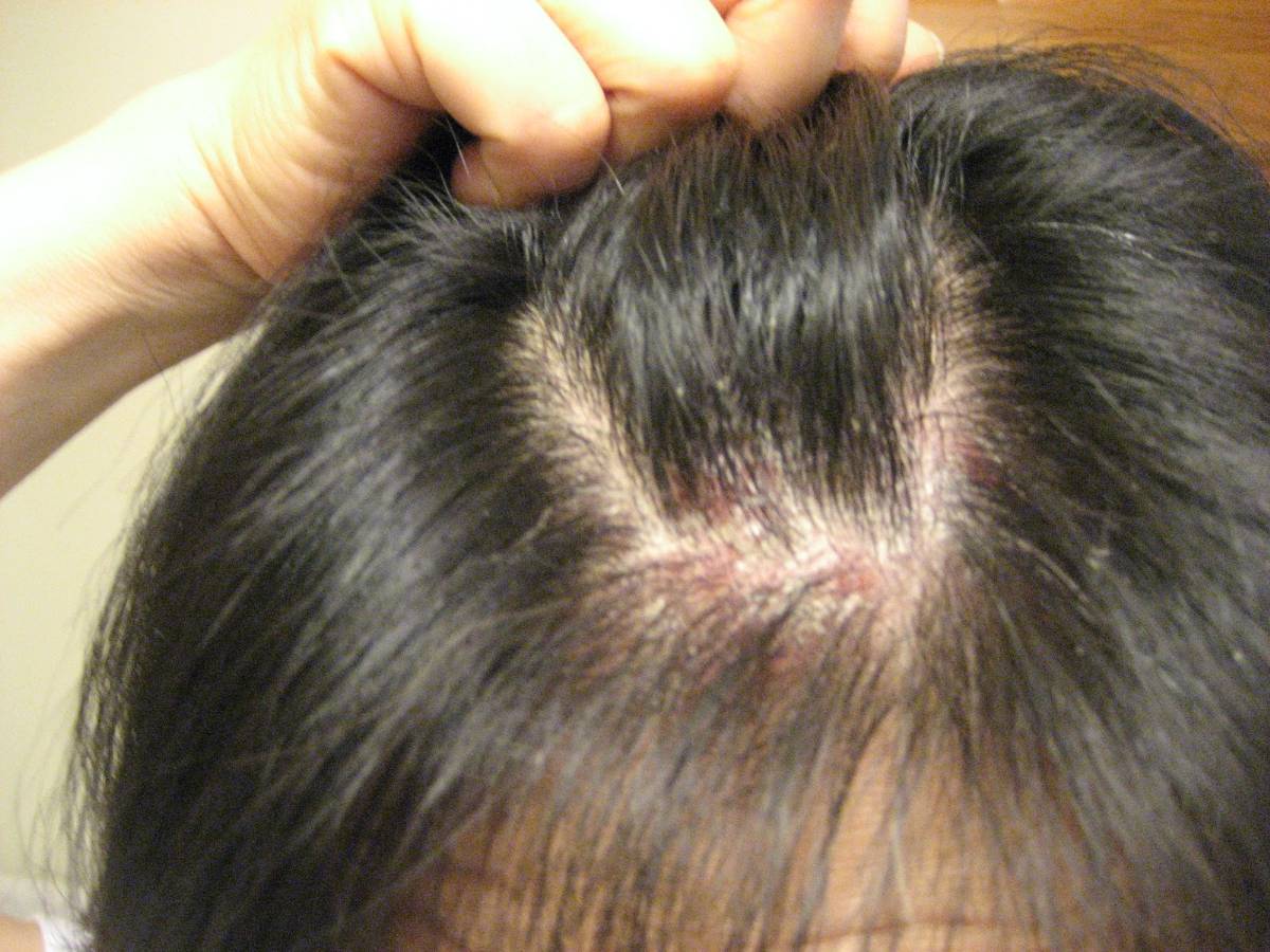 Psoriasis Of The Scalp  Causes, Symptoms And Treatment ...