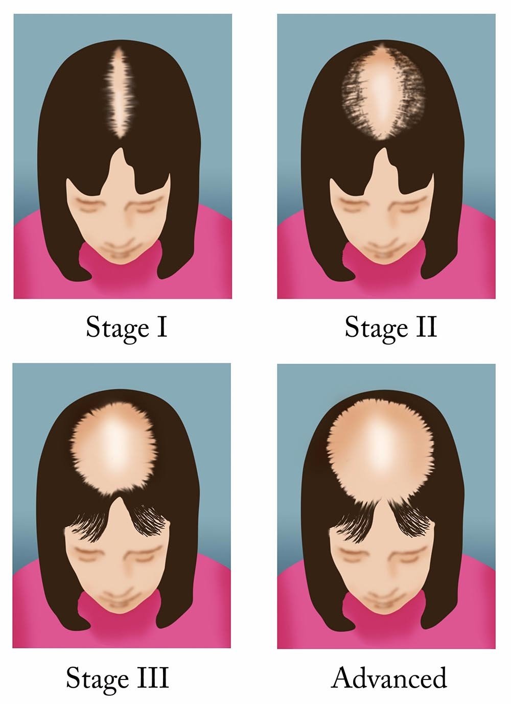 Read This Before Your Decide On Your Hair Loss Treatment ...