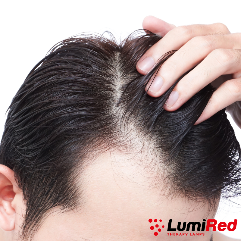 Red Light Therapy for Hair Loss Treatment