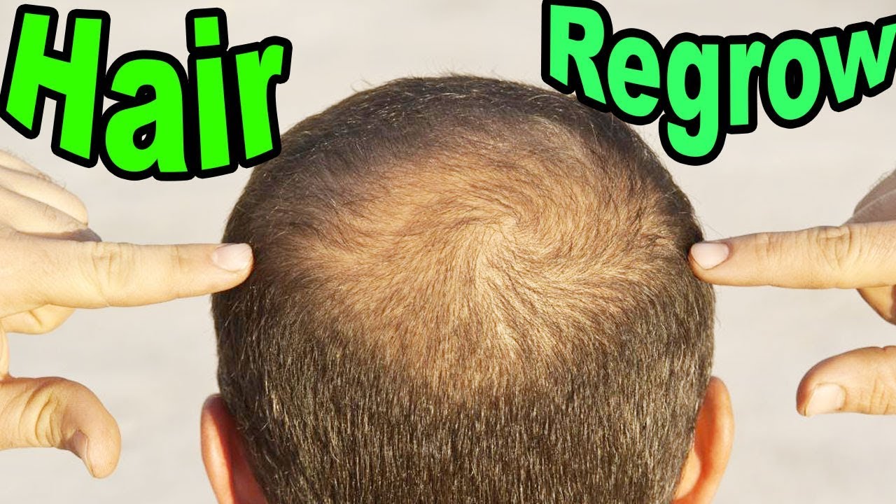 Regrow Thinning Hair Men / How To STOP HAIR FALL NATURALLY