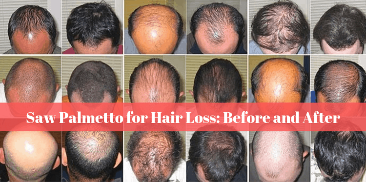 Saw Palmetto for Hair Loss: Before and After [How it Works]