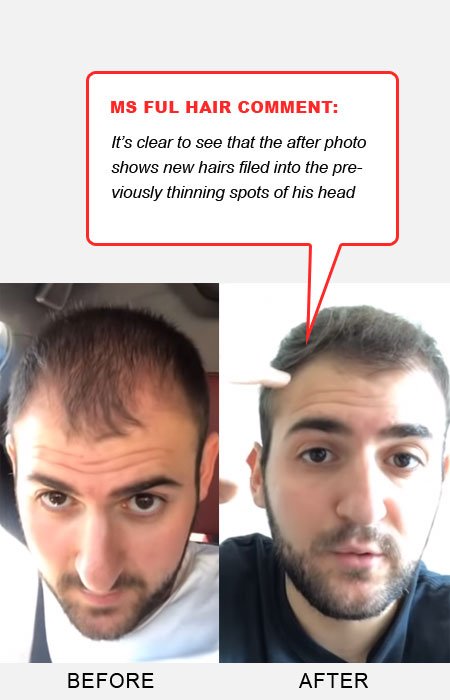 Saw Palmetto Hair Loss Reddit