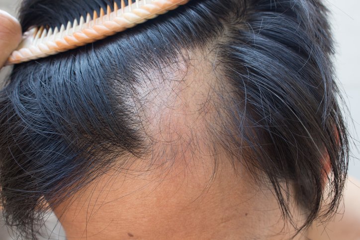 Scalp Cooling for Alopecia Among Patients With Breast Cancer