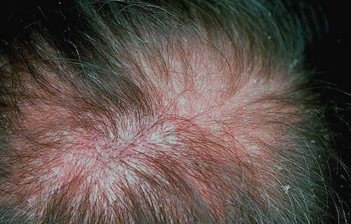 Scalp eczema and psoriasis may cause pimples