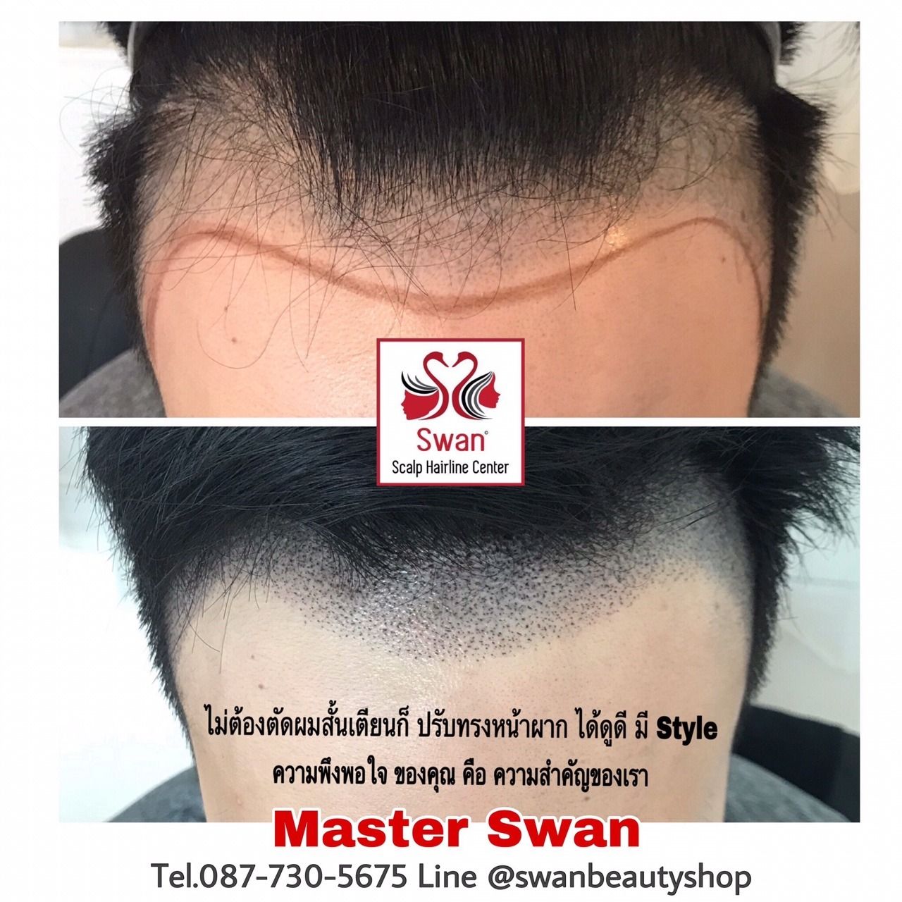 Scalp Hairline Center â Are you suffering from hair loss ...
