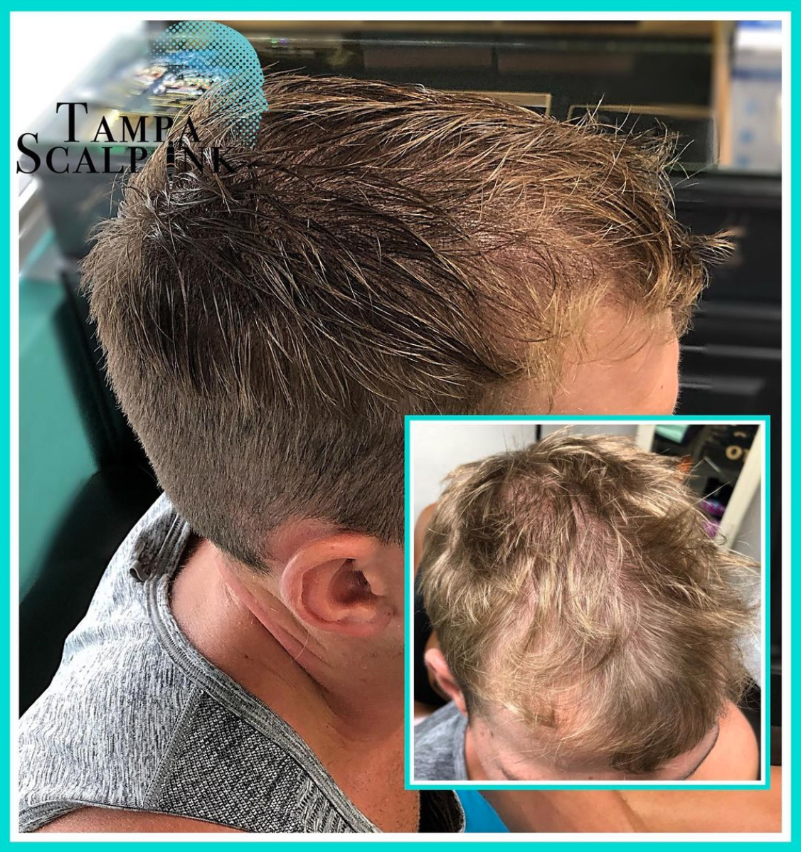 Scalp micropigmentation to cover hair thinning with a soft ...