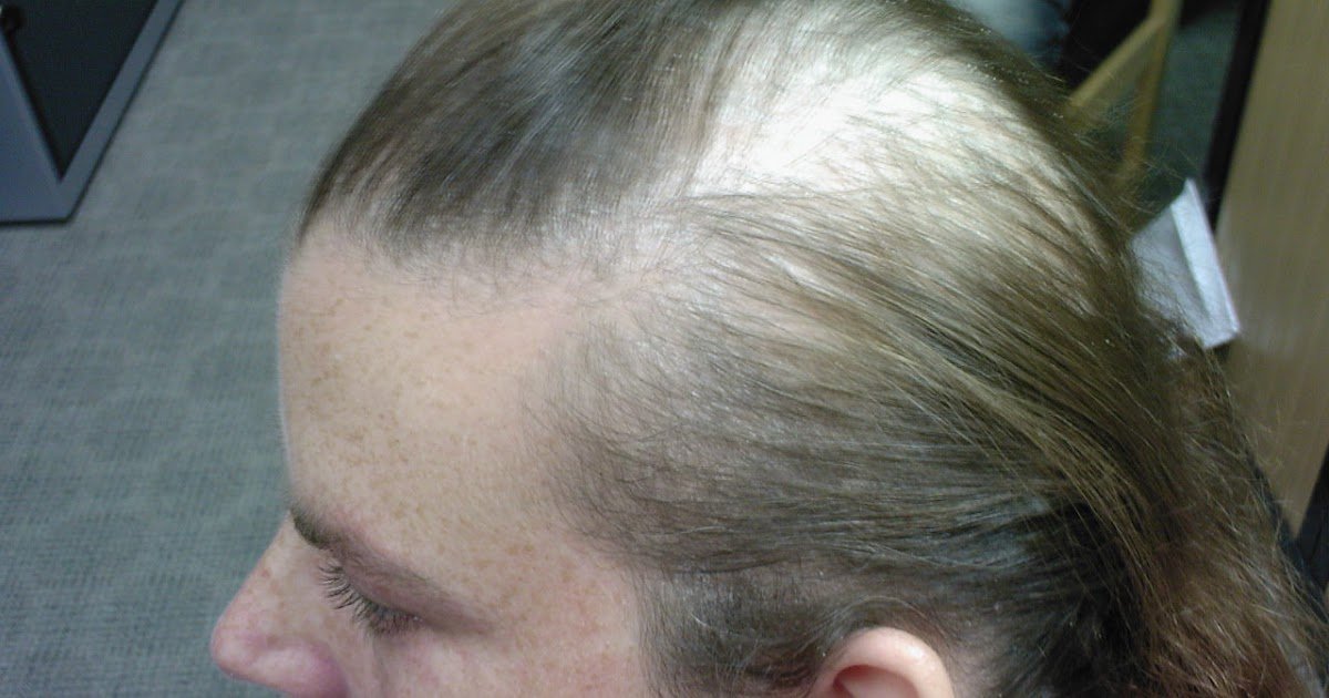 Scalp Psoriasis Hair Loss with regard to Encourage