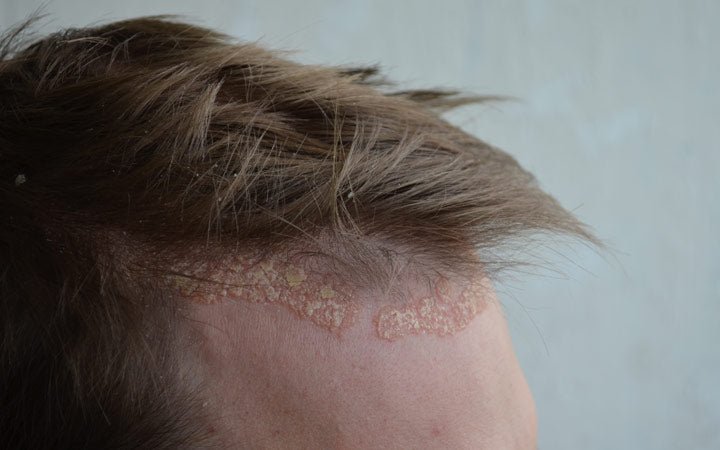 Scalp Psoriasis: Oral &  Topical Treatments, Home Remedies &  Quick Tips ...