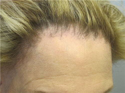 Scarring Cicatricial Alopecia