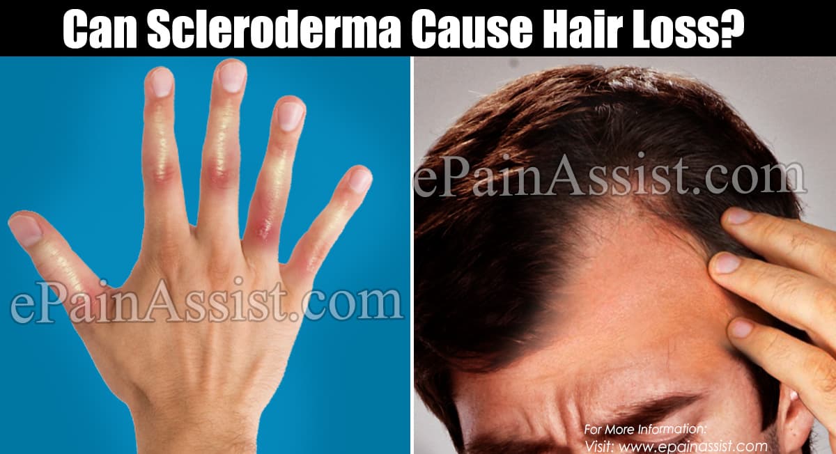 Scleroderma And Hair Loss / Amino Acids for Hair Loss