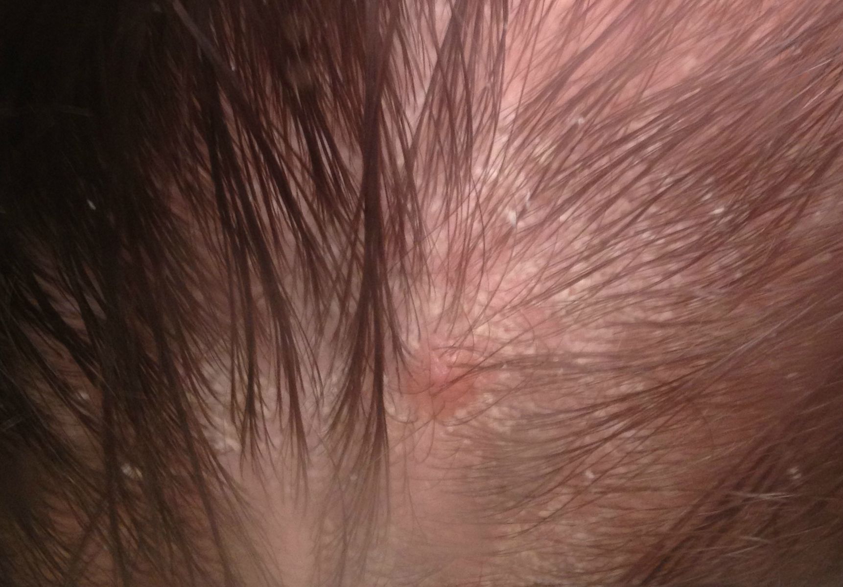 Seborrheic Dermatitis Hair loss recovery